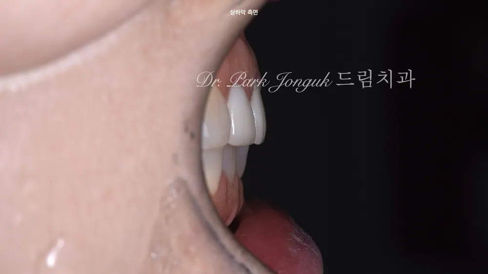 라미네이트 재시술｜크라운으로 속였던 치료, 자연스럽게 다시 태어난 앞니 본문 사진 3