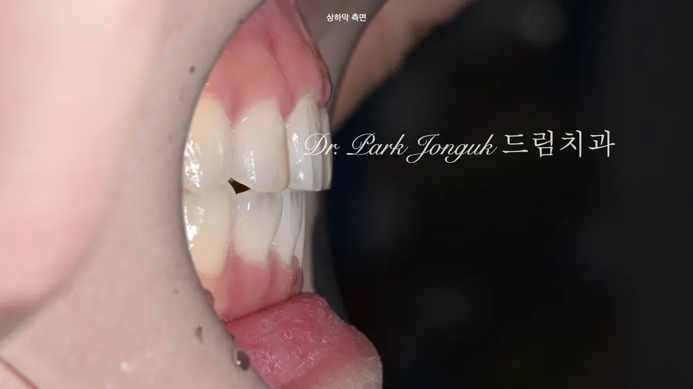 교정 후에도 앞니 충치 때문에 고민이라면 — 자연스러운 라미네이트로 해결하다 본문 사진 4