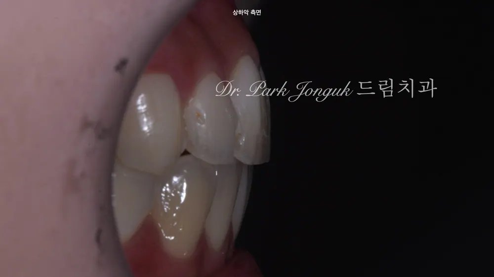 원데이 라미네이트 실패 후 재시술, 레이저로 안전하게 제거하는 방법 본문 사진 3