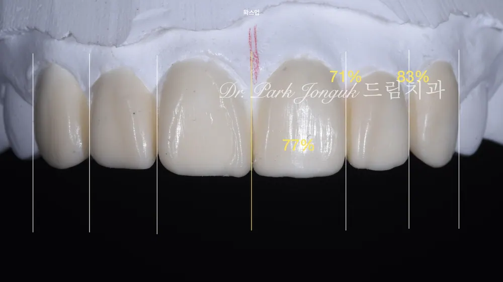 원데이 라미네이트 실패 후 재시술, 레이저로 안전하게 제거하는 방법 본문 사진 5