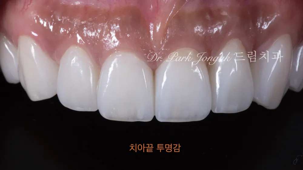 앞니 라미네이트