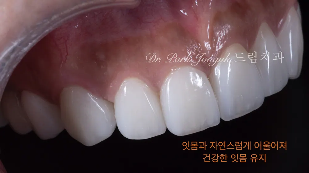 앞니 라미네이트