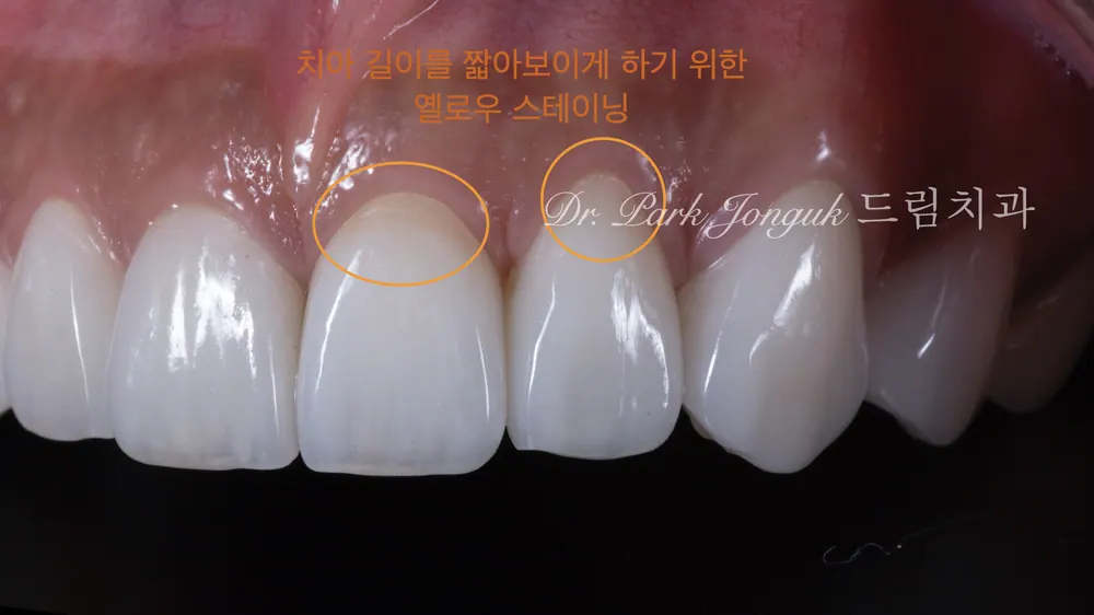 앞니 라미네이트
