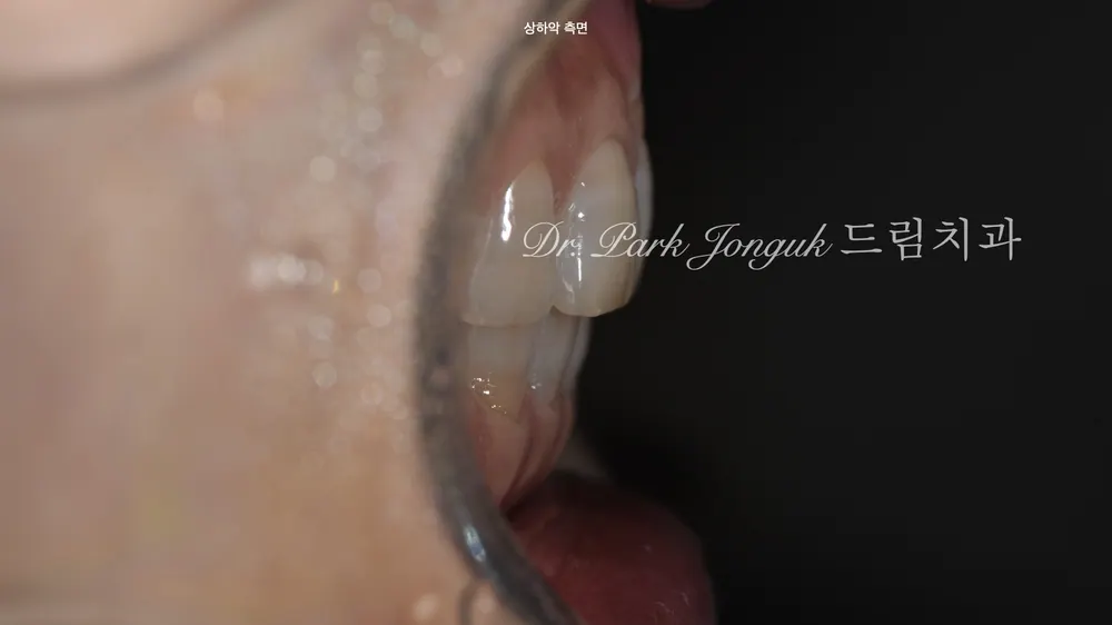 앞니 라미네이트