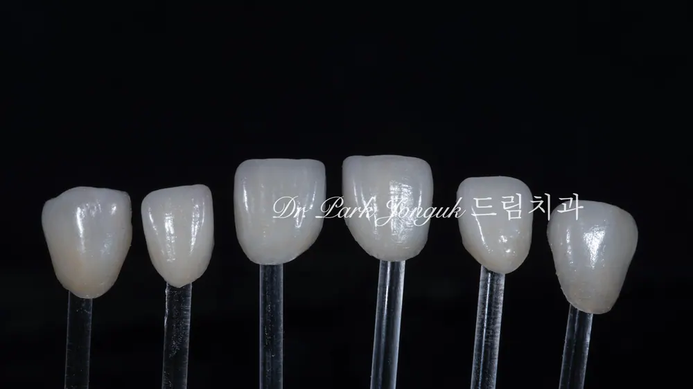 50대 라미네이트, 마취 없이 무삭제로 노화치아를 젊게 만드는 방법 본문 사진 5