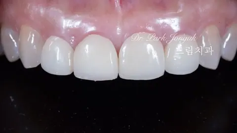 40대 라미네이트 재시술, 이상한 라미네이트를 자연스럽게 다시 만드는 방법