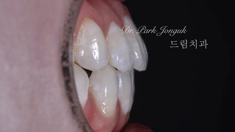 뻐드러진 치아 라미네이트