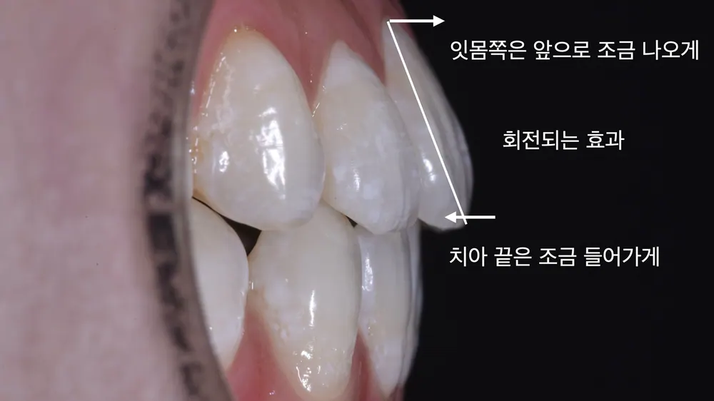 뻐드러진 치아 라미네이트