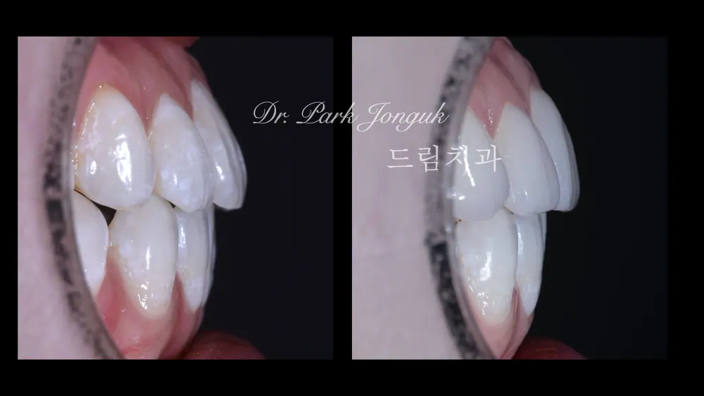 뻐드러진 치아 라미네이트