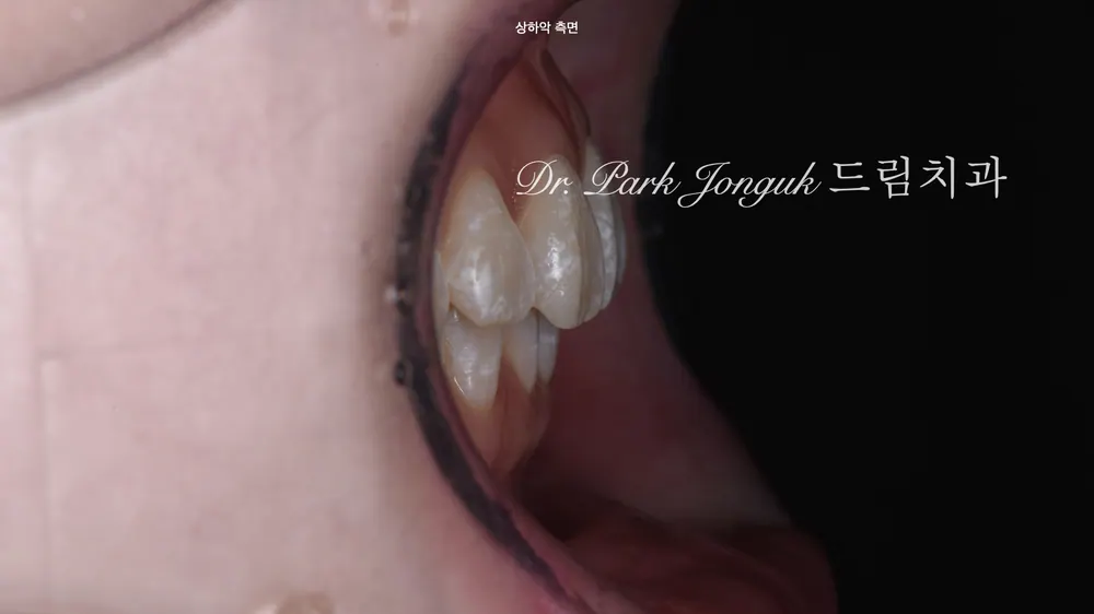 앞니 변색 얼룩 치아의 라미네이트 치료