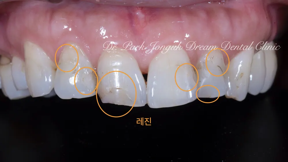 앞니 충치 레진 변색 라미네이트