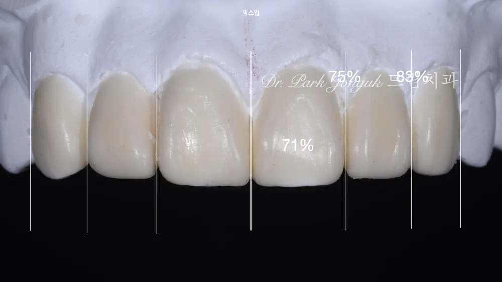 앞니 레진 변색 라미네이트