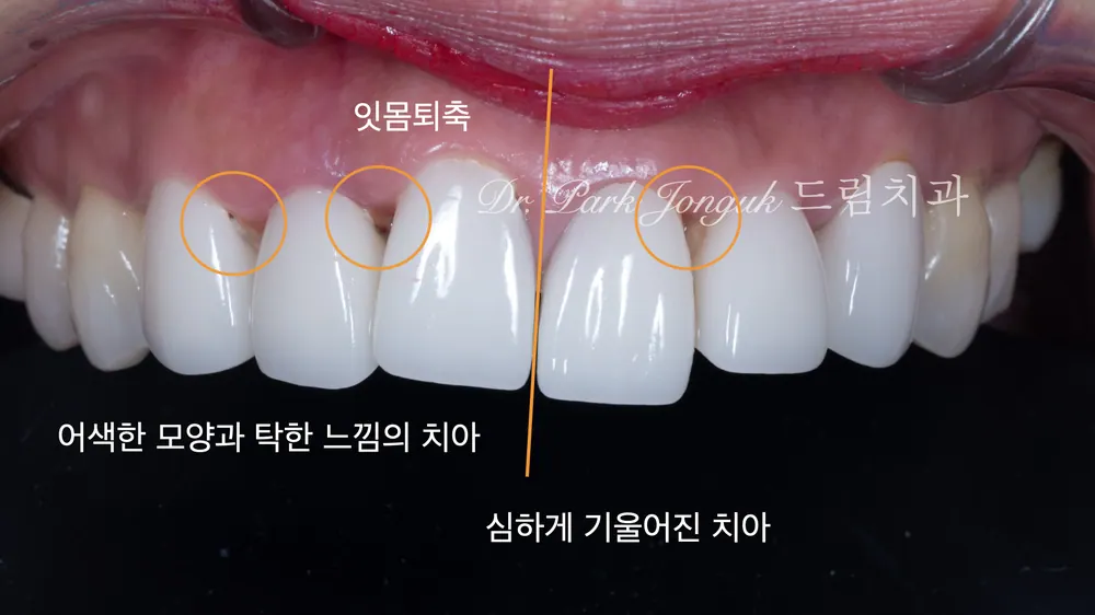 라미네이트 재시술