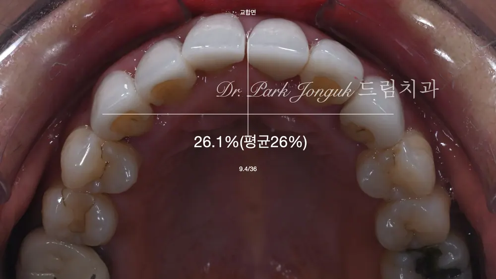 [라미네이트 재시술] 10년 전 시술 실패? ❌ 잇몸 기울기, 과도한 삭제까지 극복한 재치료 전문 명품 해법 본문 사진 5