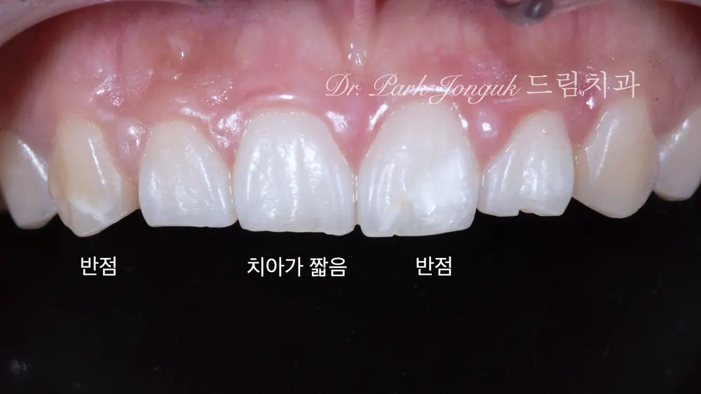 앞니 라미네이트