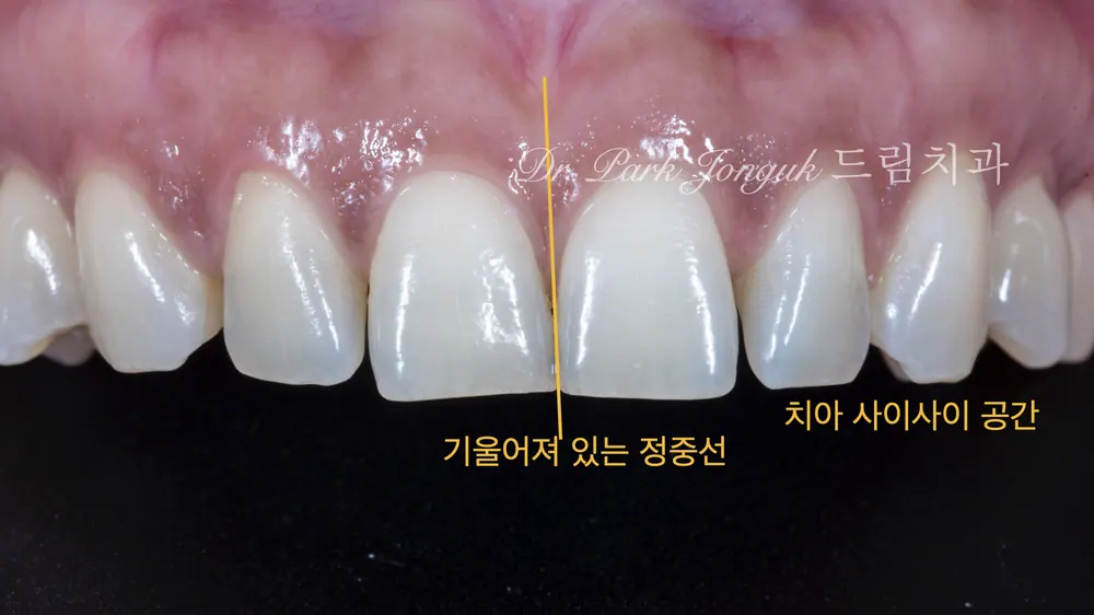 벌어진 앞니 치아 라미네이트