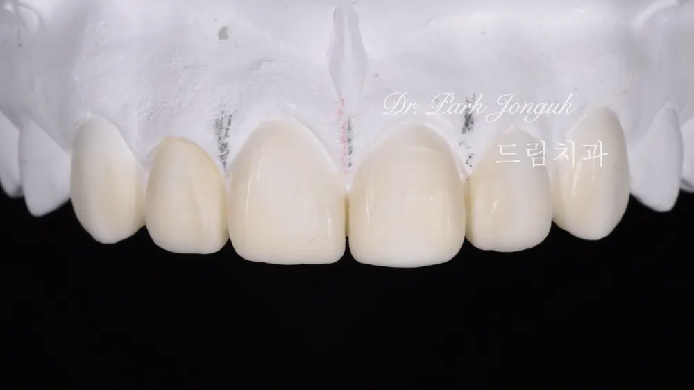 강남 앞니 레진 라미네이트 재시술