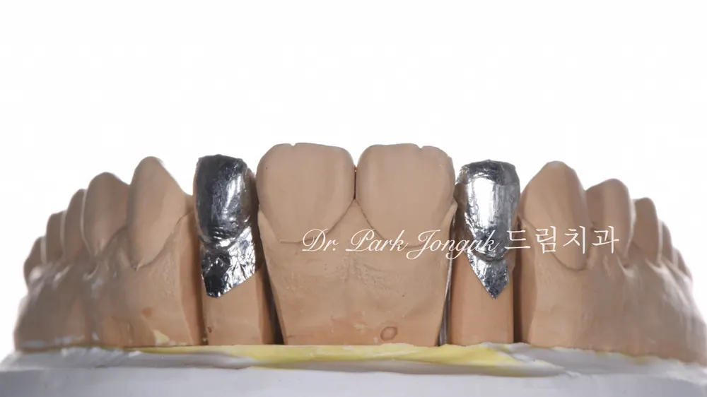 교정후 앞니 두개 왜소치 무삭제 라미네이트