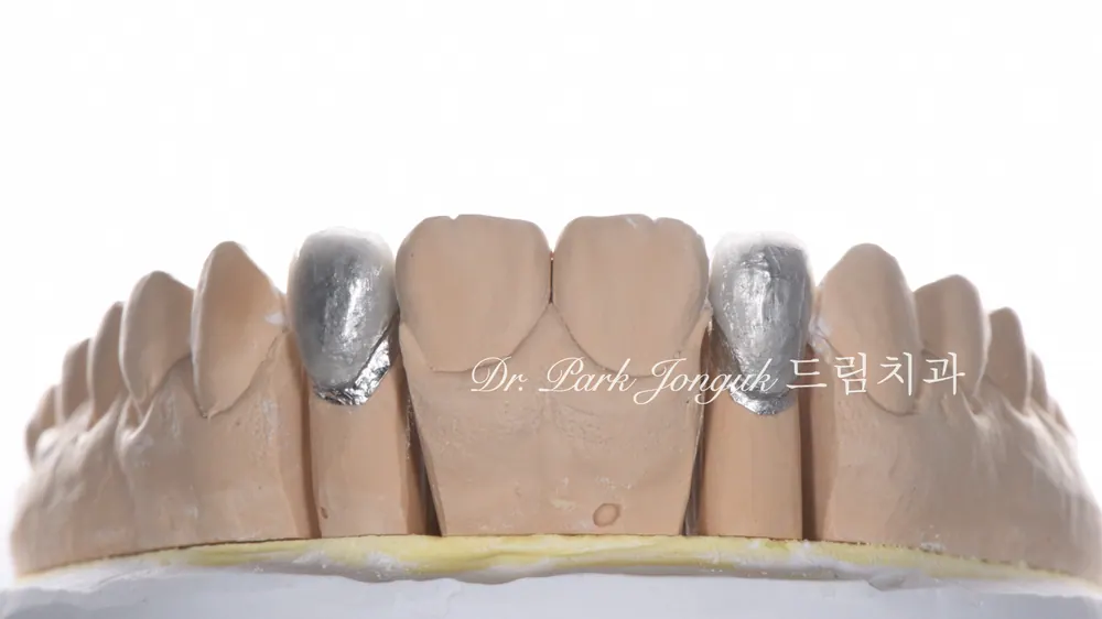 무삭제 라미네이트, 왜소치를 자연스럽게 개선하다 - 교정 후 라미네이트 실제 케이스 본문 사진 7