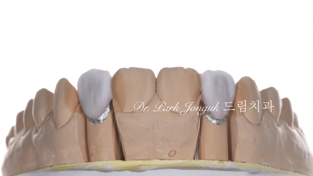 교정후 앞니 두개 왜소치 무삭제 라미네이트