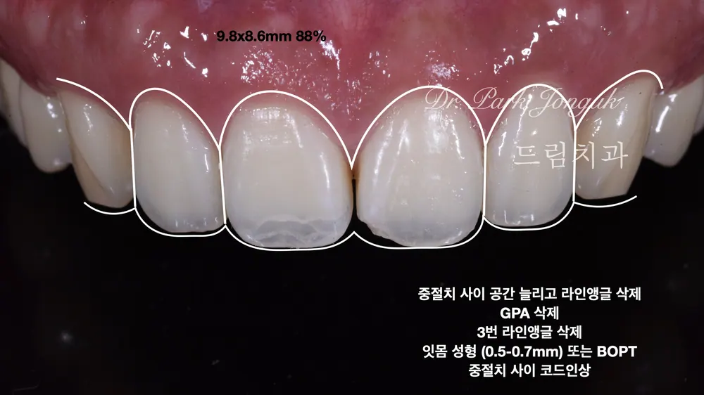 교정후 옥니 무삭제 라미네이트
