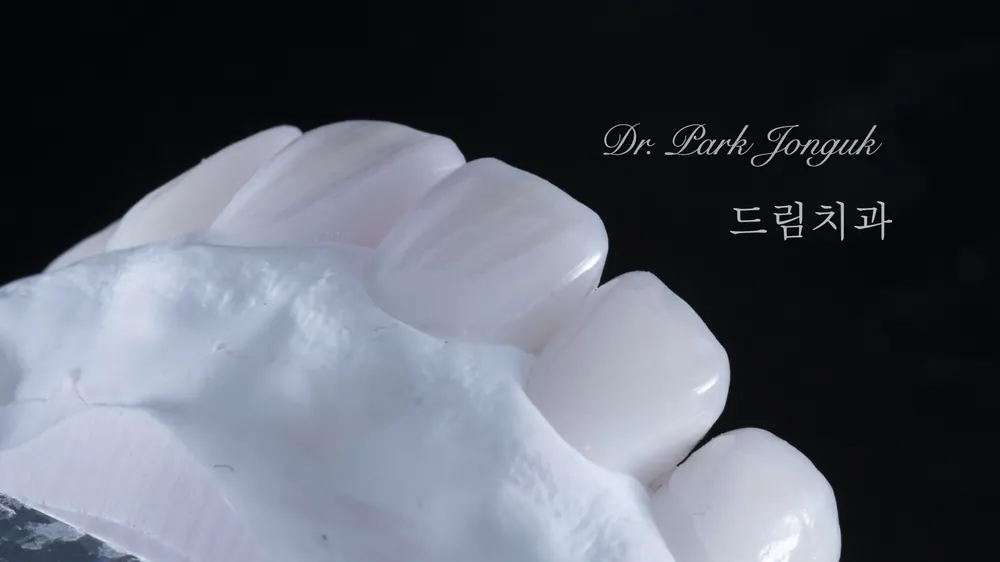 교정후 옥니 무삭제 라미네이트