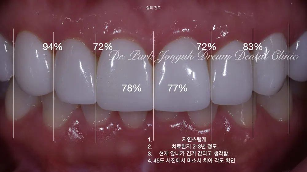 라미네이트 재시술