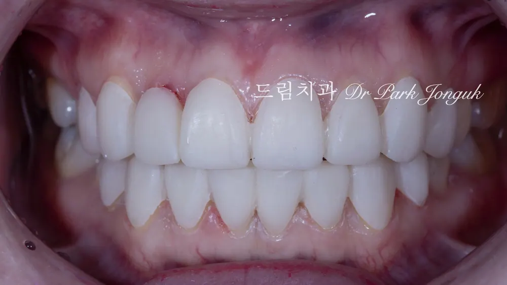 강남 토끼이 라미네이트 잘하는곳