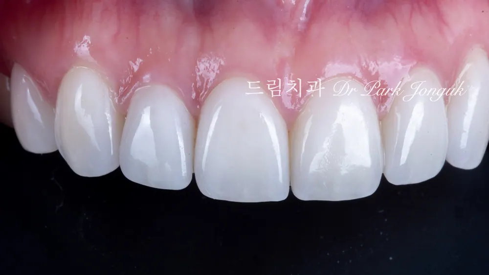 강남 토끼이 라미네이트 잘하는곳