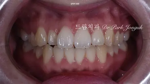 토끼이 라미네이트, 교정 없이 빠르고 자연스럽게 해결하다 - 강남 라미네이트 실제 케이스