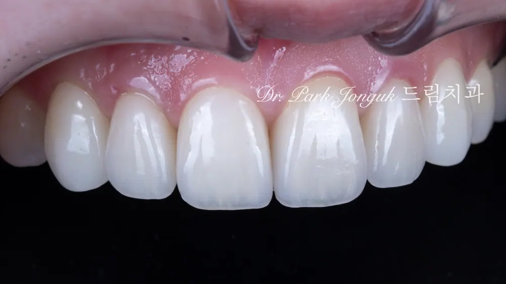 강남 라미네이트 재시술 잘하는 곳