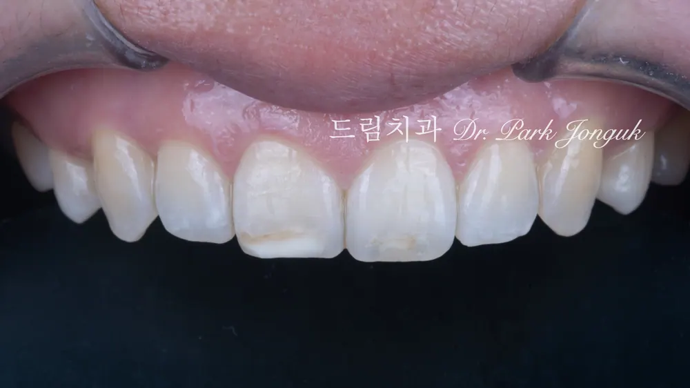 무삭제 라미네이트