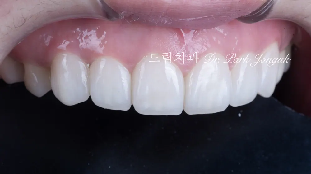 무삭제 라미네이트