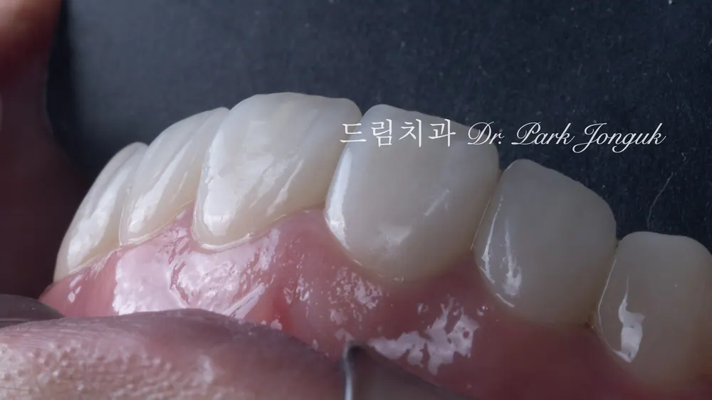 무삭제 라미네이트