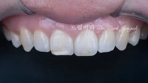 [무삭제 라미네이트] 앞니 백색반점(White Spot), 치아가 작지 않아도 무삭제가 가능했던 이유 (박종욱 원장)