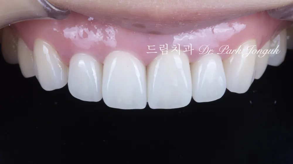 앞니 라미네이트 올세라믹 크라운 재시술