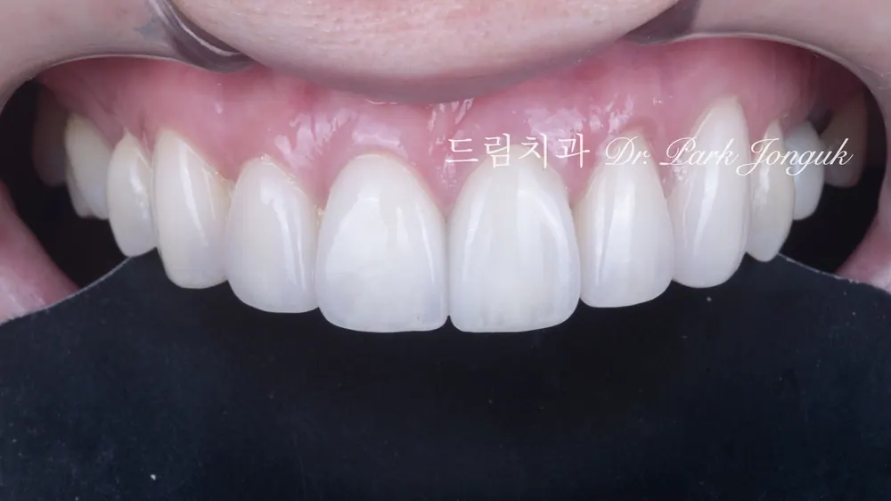 앞니 라미네이트 올세라믹 크라운 재시술