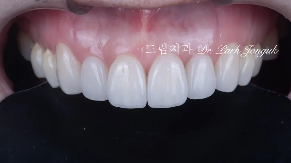 앞니 라미네이트 올세라믹 크라운 재시술