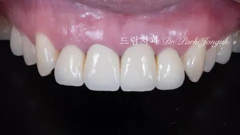 라미네이트 재시술｜앞니가 어색할 때, 다시 해야 하는 이유와 3가지 대표 케이스