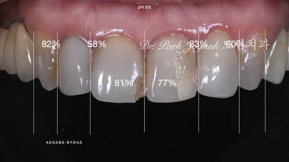 올세라믹 크라운 재시술 강남 라미네이트 잘하는 곳