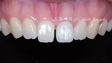 올세라믹 크라운 재시술과 무삭제 라미네이트를 동시에 맞춘 사례｜앞니 심미치료의 최고 난이도 케이스