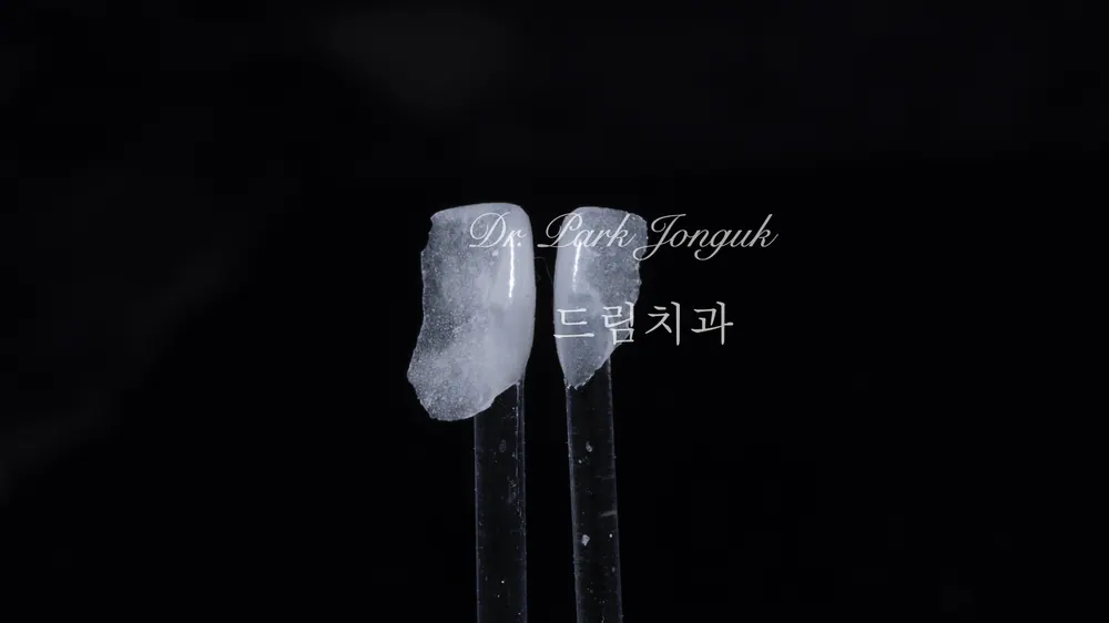 벌어진 앞니 무삭제 라미네이트