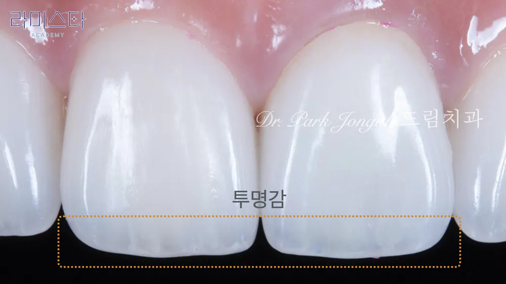 강남 라미네이트 잘하는 곳 자연스러운 라미네이트