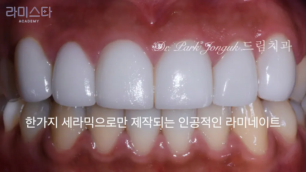 강남 라미네이트 잘하는 곳 자연스러운 라미네이트