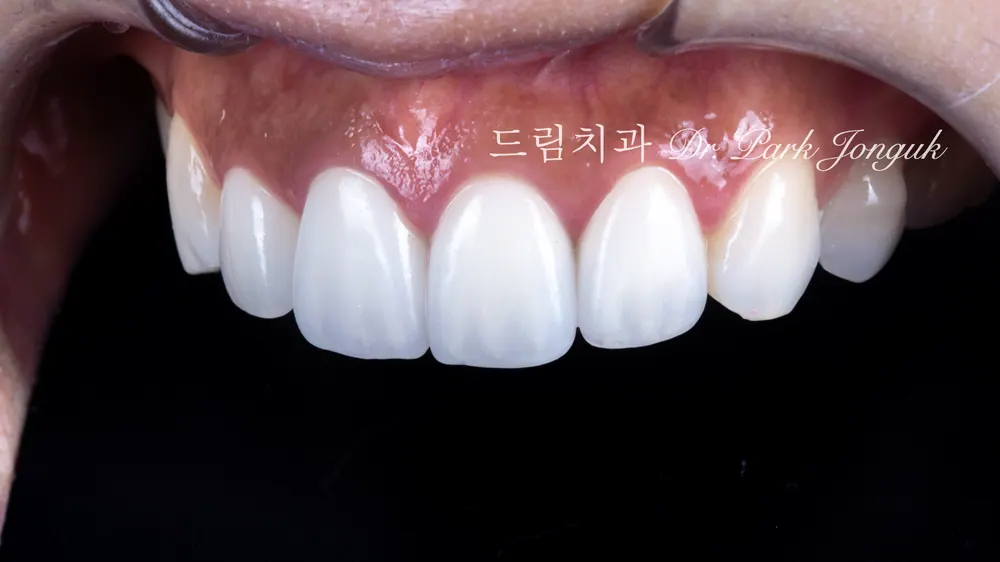 올세라믹크라운 라미네이트 파절 깨짐 재시술