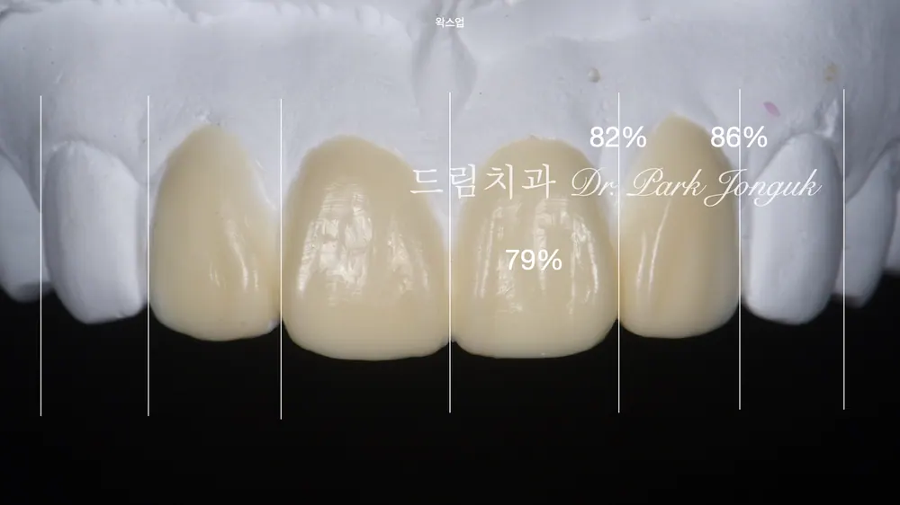 앞니 라미네이트 재시술