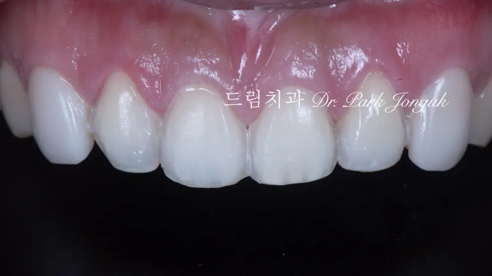 앞니 라미네이트 재시술