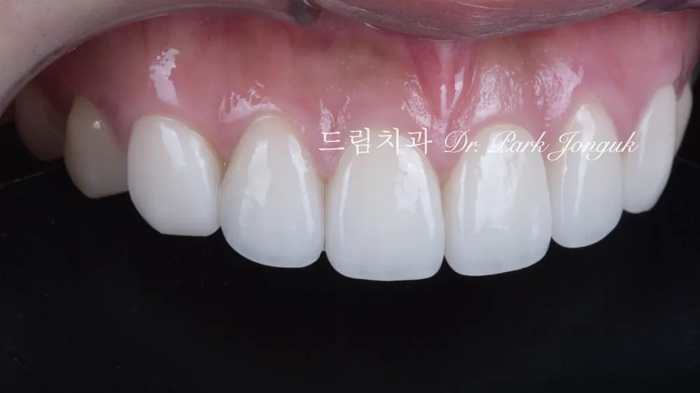 앞니 라미네이트 재시술