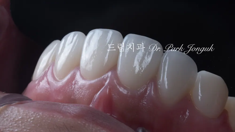 앞니 라미네이트 재시술