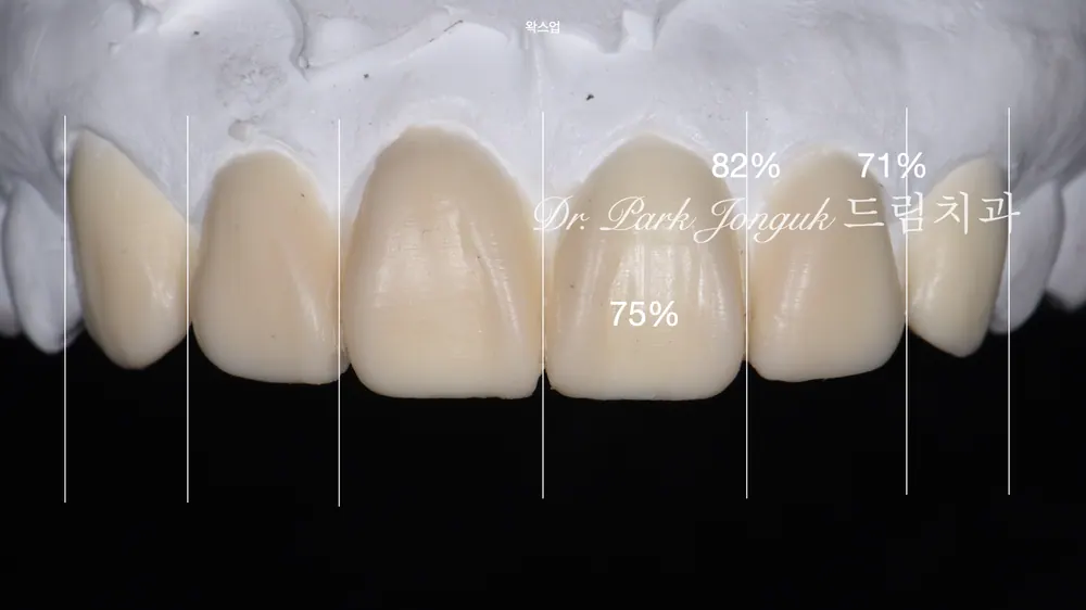 테트라사이클린 치아 변색 어두운치아 라미네이트